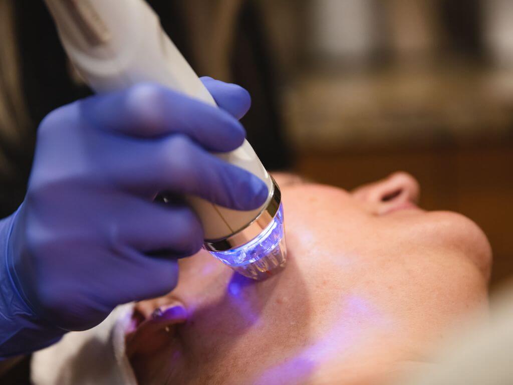 A close-up of a professional skincare treatment of RF microneedling on a patient’s face.