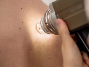 Close-up of mole examination with dermatoscope.