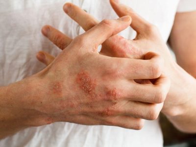 lose-up of eczema rash on hands showing red, inflamed patches that need eczema treatment