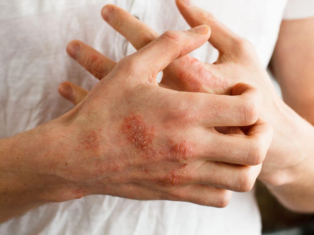 lose-up of eczema rash on hands showing red, inflamed patches that need eczema treatment