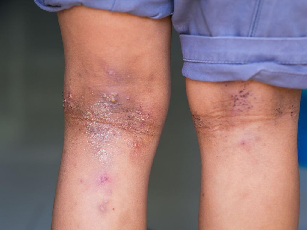 Eczema symptoms on the back of a child’s knees with dry, cracked, inflamed skin