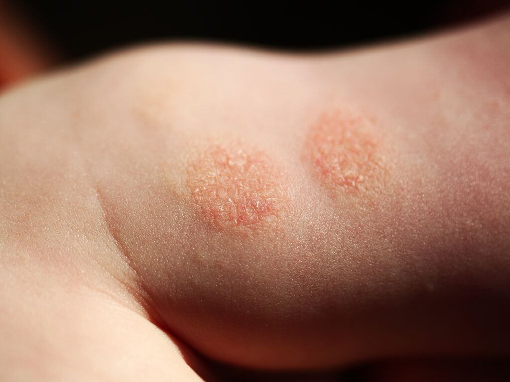Nummular Dermatitis eczema rash on a baby’s skin showing red, scaly patches