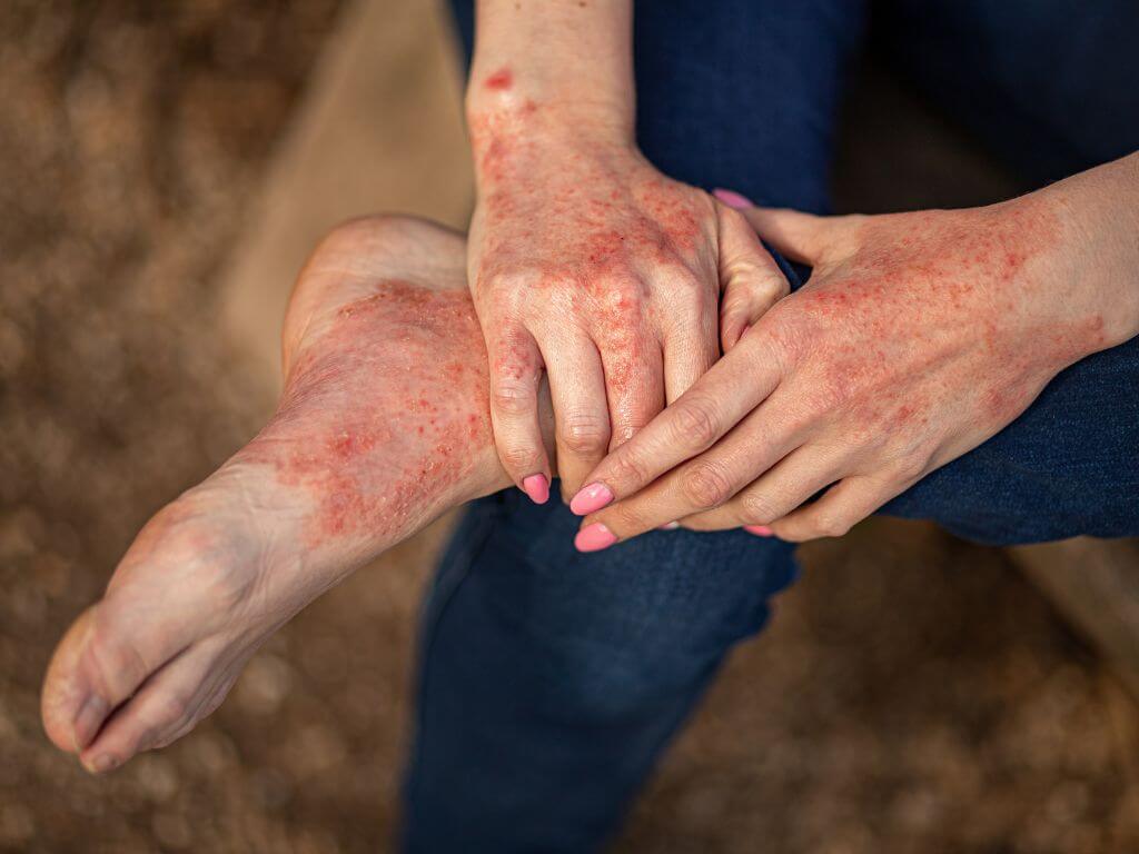 Eczema flare-up on hands and feet with red, irritated patches of skin