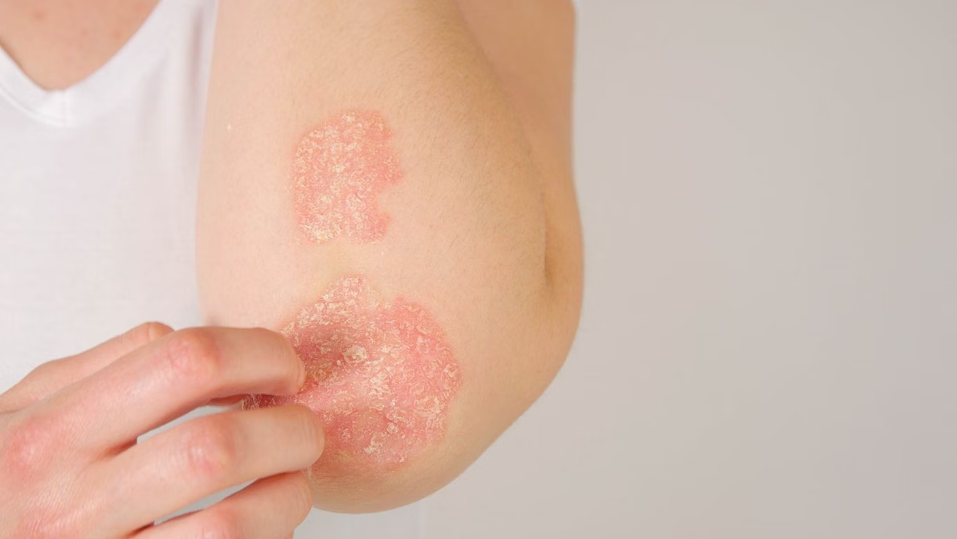 Psoriasis treatment | Dermatologist in Johannesburg